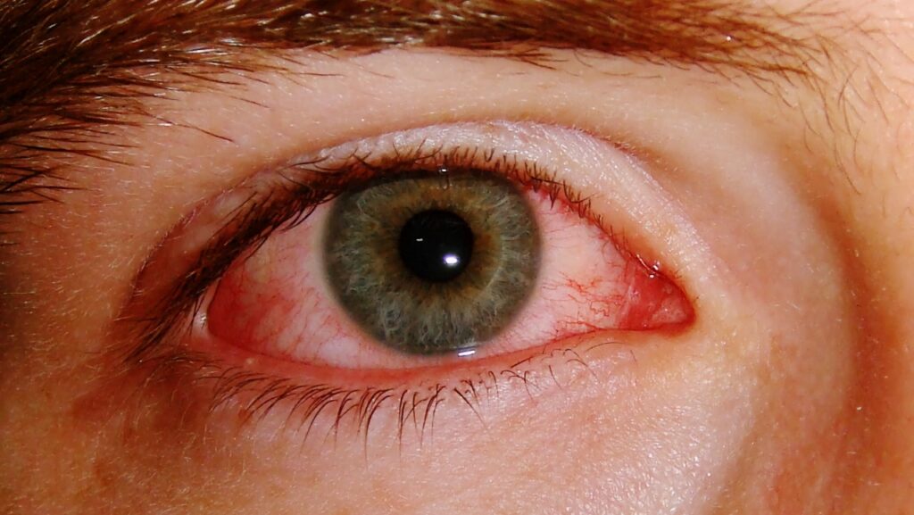 Konjunktivitis kod male djece: Uzroci, simptomi i lijeenje | BL Portal