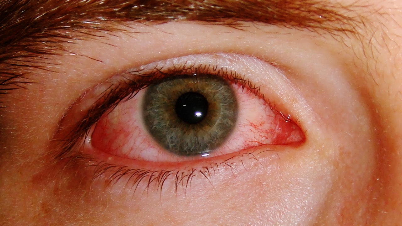 Konjunktivitis kod male djece: Uzroci, simptomi i liječenje