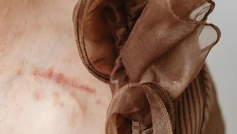 Spriječite infekciju: Kako ukloniti ožiljke prirodnim putem