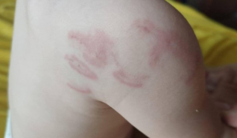 Slučaj u BiH! Tužilaštvo vrši provjere u slučaju bebe koja je 14 puta izgrižena u vrtiću