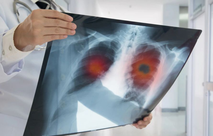 Ovo su simptomi raka pluća: Kako ih prepoznati i reagovati na vrijeme