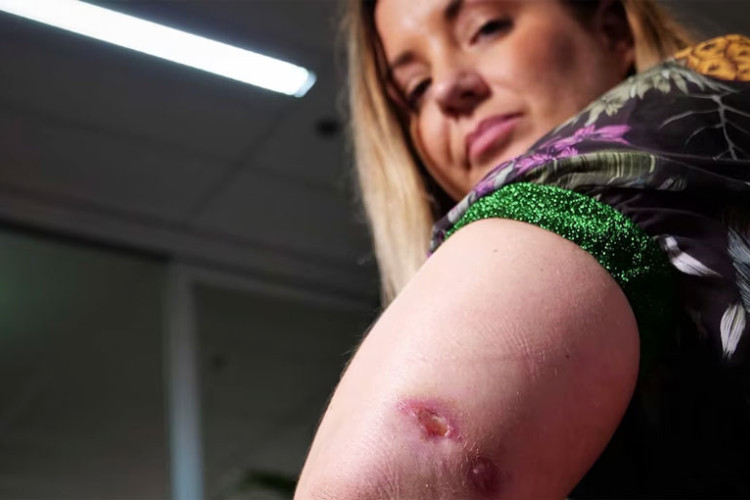 Zvaničnici zabrinuti: Raste broj slučajeva bakterije koja jede meso