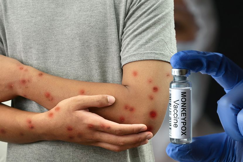 Haos u Njemačkoj: Zatvorena škola, kod djece otkriven novi soj virusa majmunskih boginja