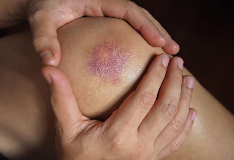 Pad na ledu zna biti bolan: Uz pomoć ova tri trika nestaju modrice