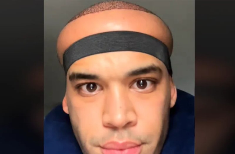 Šokantna rekacija! Htio više kose pa mu se glava deformisala: “O, Bože, šta se dešava”