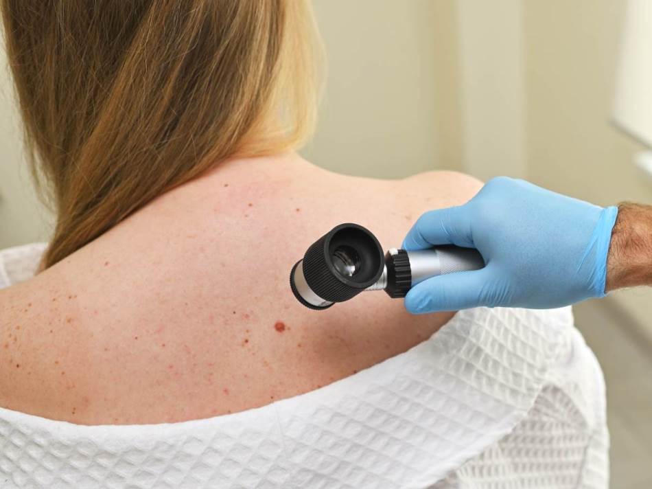 Broj oboljelih od melanoma u Srpskoj u ekspanziji: “Nije zdravo sve što sija”