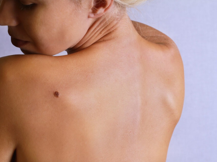 Pokazatelj nečije sudbine: Ako imate mladež na nekom od ovih djelova tijela – pravi ste srećnik