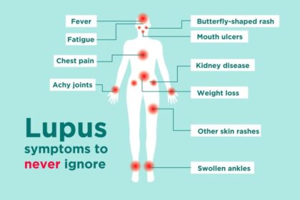 Lupus – misteriozna bolest koja napada iz sjenke, ali uz pravu terapiju život je moguć