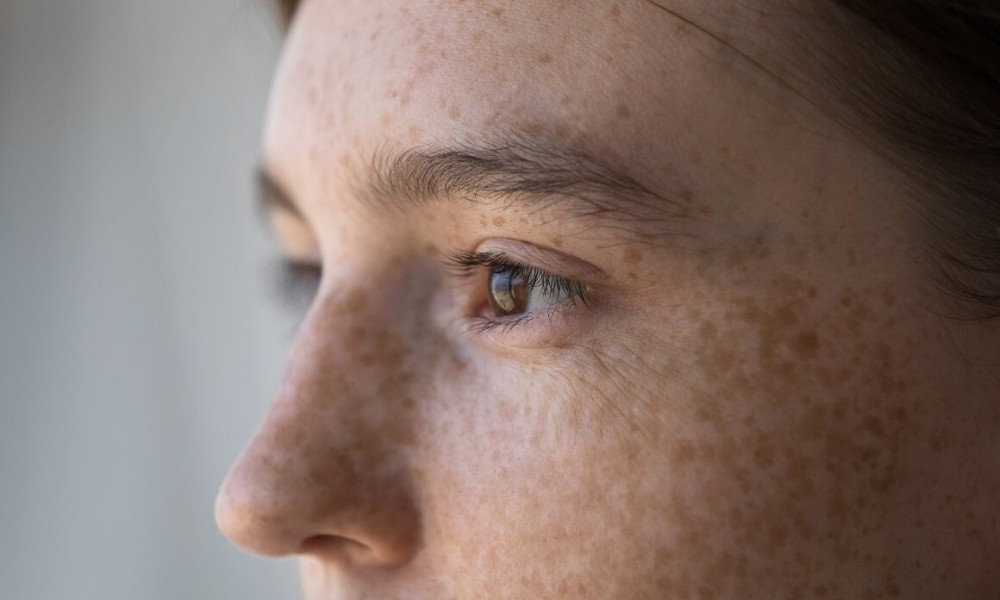 Prekomjerno izlaganje suncu: Šta su sunčane pjege i kako ih se riješiti?