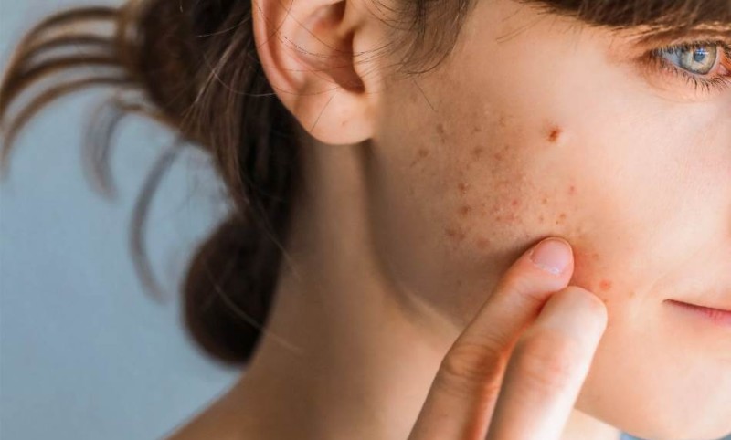 Akne na licu govore o stanju unutrašnjih organa: Prepoznajte problem na vrijeme