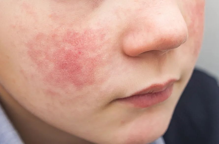 Šta je peta bolest i kako se prenosi?