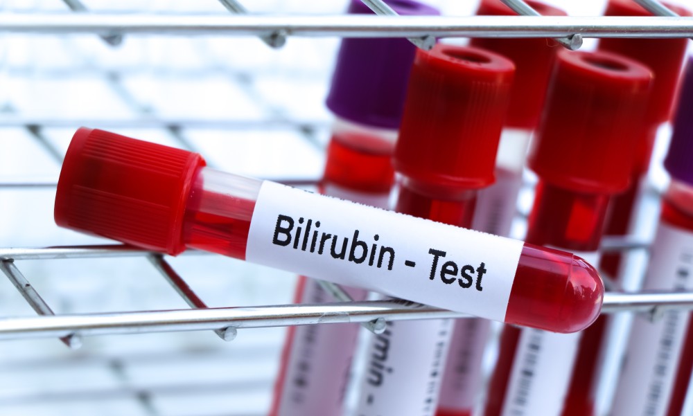 Istraživanje dalo rezultate: Šta znači kada je bilirubin povišen