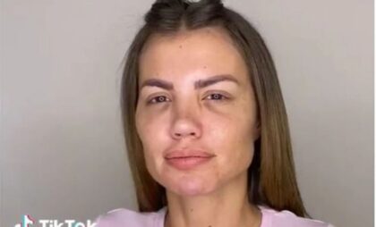 Iskeširala “brdo” novca: Bivša modelsica zbog estetskih operacija umalo ostala bez nosa