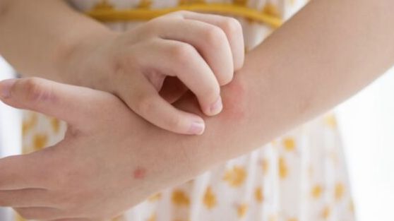 U FBiH sve više i slučajeva šuge: “Mnogi zbog stida ne žele da priznaju da su se zarazili”