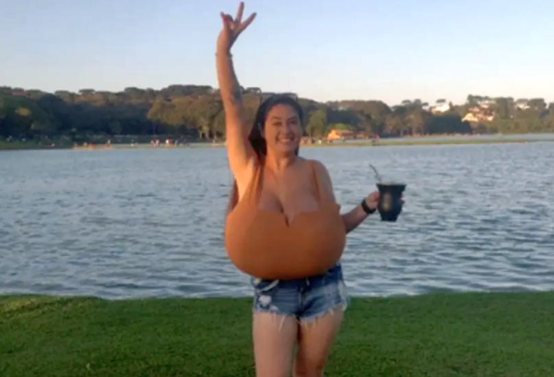 Grudi su joj teške više od13 kilograma, zbog njih ima invalidska kolica: I dalje rastu, život joj je borba