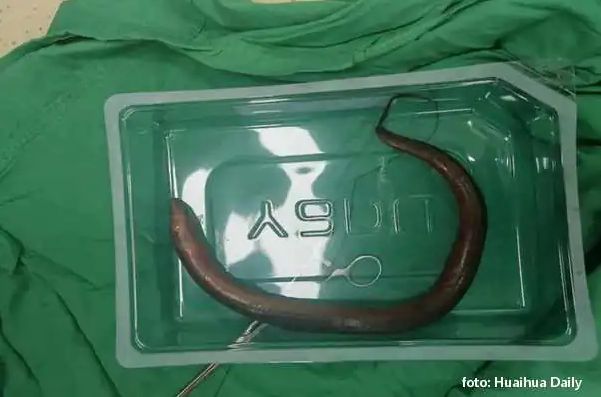 Ljekari mu u stomaku našli živu jegulju!