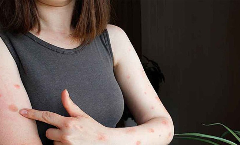 Budite oprezni: Naučnici tvrde da Mpoks virus može da inficira i ljudski mozak