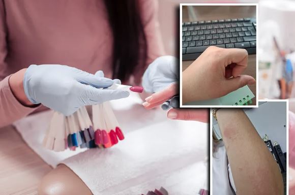 “Svrab je nenormalan”: Nina dobila jezive pečate po tijelu od popularnog gel laka