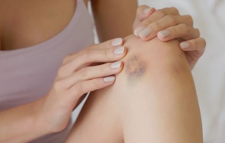 Rani pokazatelji nedostatka vitamina C – ne treba ih ignorisati