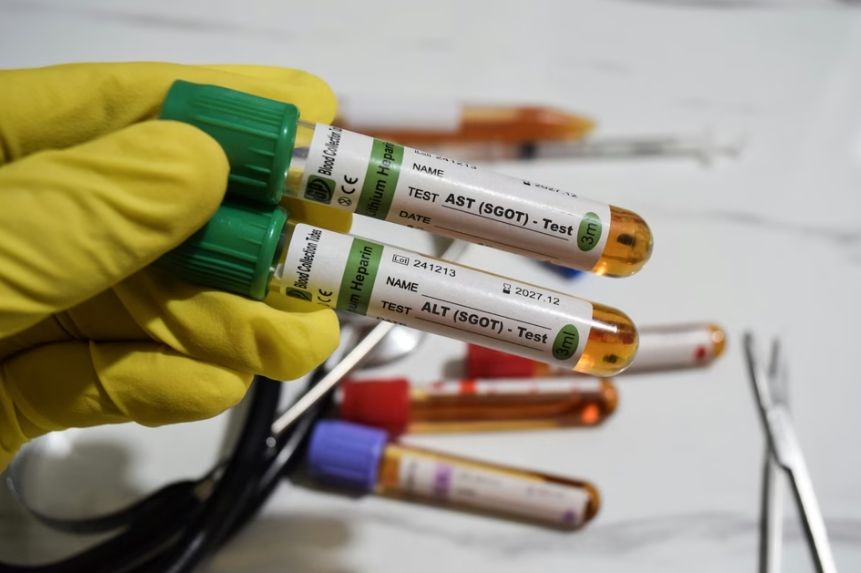 Kako smanjiti ALT u krvi?