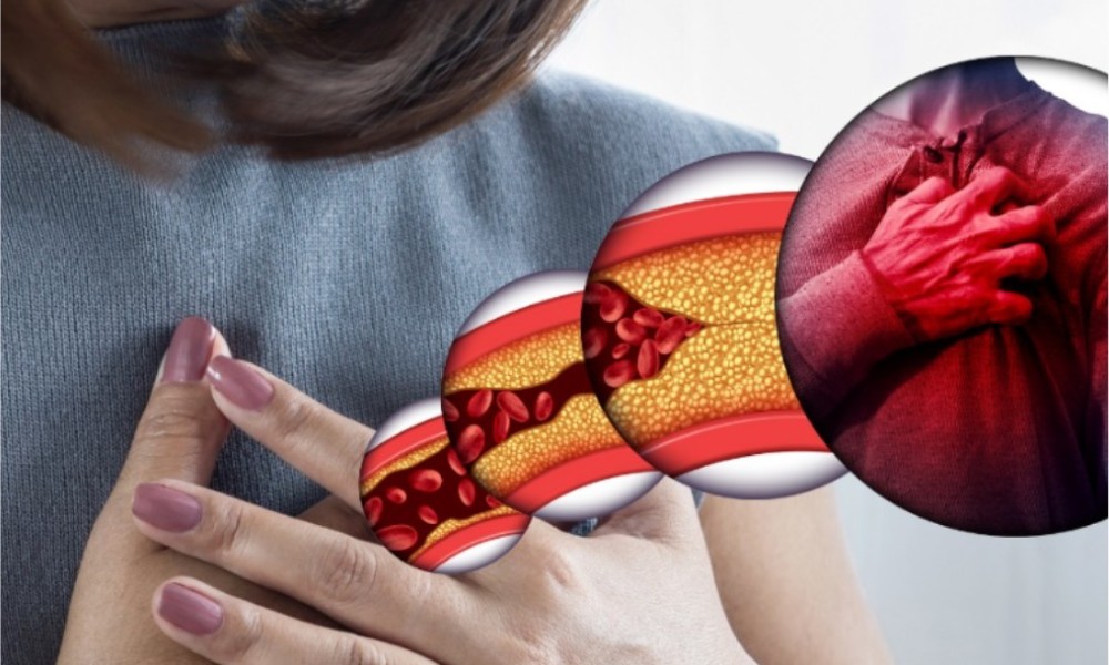 Kardiolog otkriva: Evo koja je hrana prava noćna mora za arterije