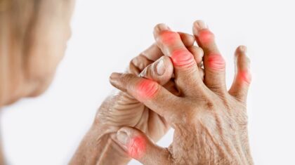 Giht se češće javlja kod muškaraca: Kako se dijagnostikuje i liječi ova bolest