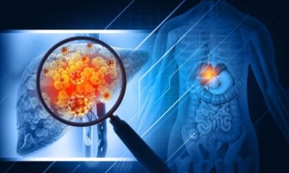 Negativno utiču: Ove namirnice su glavni krivci za masnu jetru