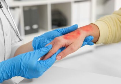 Povrede koje nas mogu zadesiti kada se najmanje nadamo: Šta staviti na opekotine?