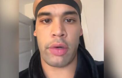 Umjetnik otišao na presađivanje kose, ali zbog šokantne nuspojave postao hit na mrežama VIDEO