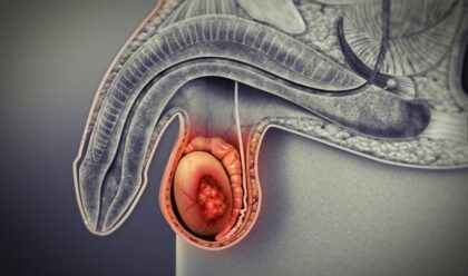 Rak testisa: Koji su simptomi i koje vrste postoje