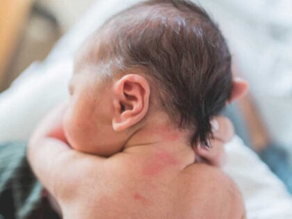 Poljubac anđela ili ujed rode: Gdje se nalazi i kako izgleda biljeg koji ima svaka treća beba