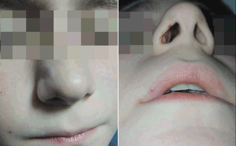 Vršnjačko nasilje u školi u BiH: Otac piše krivičnu prijavu jer su mu napali dijete