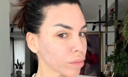 Kaja Ostojić bez šminke i filtera: Lice kao da je puno ožiljaka, otkrila o čemu se radi