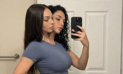 Stvarne ili digitalna iluzija: Da li su ove sijamske bliznakinje plod vještačke inteligencije