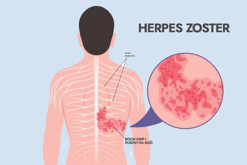 Herpes zoster praćen nekad nesnosnim bolom u porastu, pacijenti su i mlade osobe