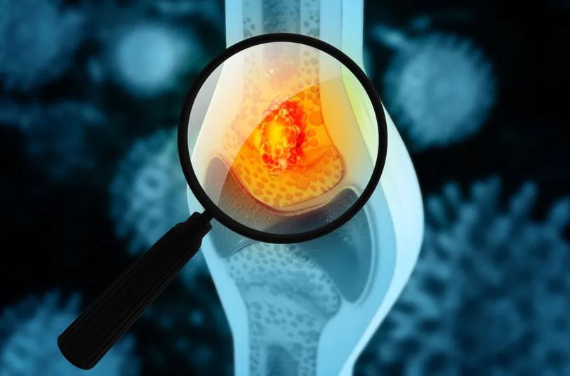 Tihi simptomi raka kostiju: Kakav bol i u kom dijelu tijela može da bude alarm upozorenja