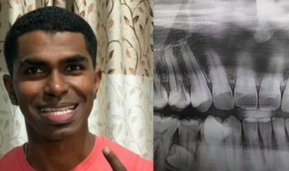 Prathab drži rekord: Ovaj čovjek ima 42 zuba – ovo je njegova priča VIDEO/FOTO