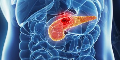 Hrana koja uništava pankreas: Doktori upozoravaju da je mnogi jedu svaki dan