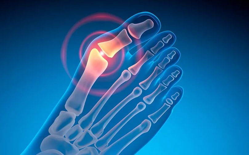 Ortopedski hirurg razotkriva mitove o čukljevima i mogućnostima liječenja, da li je obuća krivac?