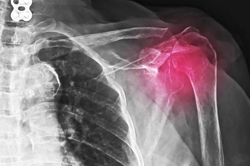 Zašto nastaje kalcifikacija, proces koji se razvija čak i na organima na kojima ne bi smio