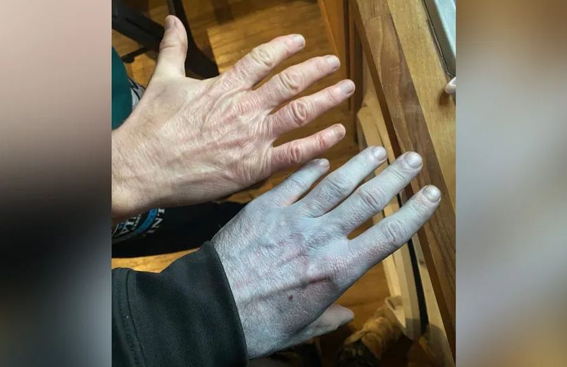 Probudio se potpuno plav i hitno otišao u bolnicu: Nakon pregleda ljekari su počeli da se smiju FOTO