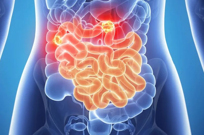 Do 2050. godine rak gastrointestinalnog trakta imaće dvostruko više ljudi, upozoravaju stručnjaci