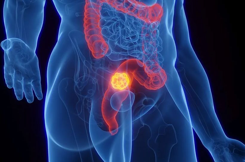 Naviku koju mnogi smatraju bezazlenom nova studija dovodi u vezu sa jednim od najtežih karcinoma