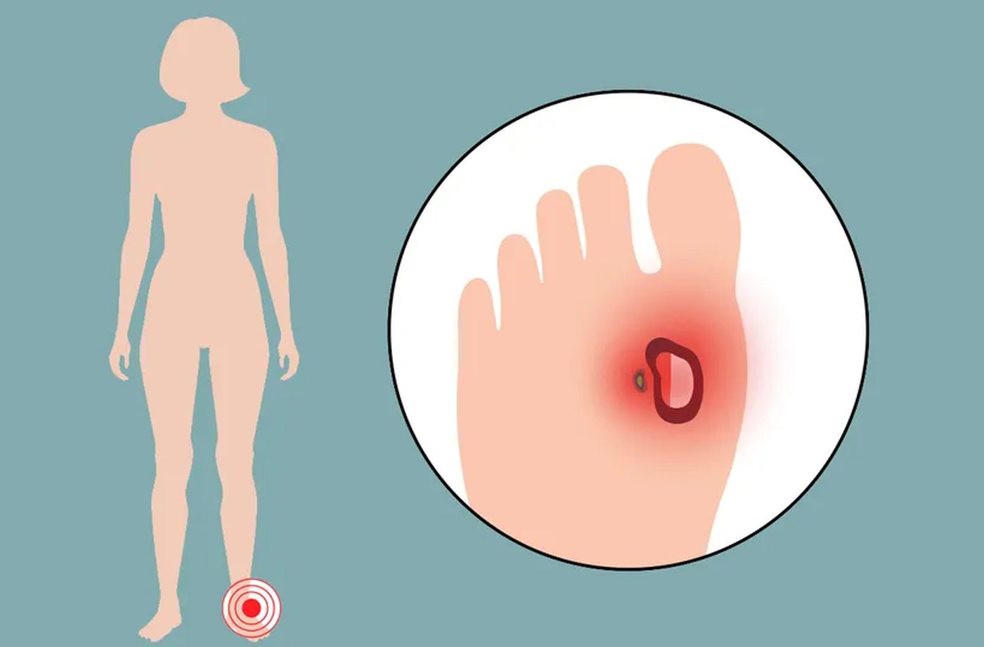 Sitan žulj može da preraste u ozbiljnu infekciju kod dijabetesnog stopala