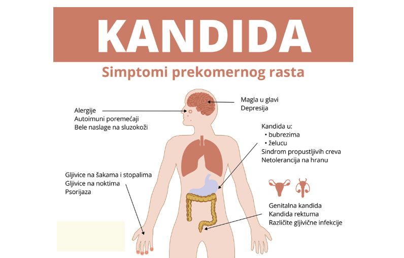 Zašto se kandida prekomjerno razmnožava u organizmu i kako da je obuzdamo ako postoji problem