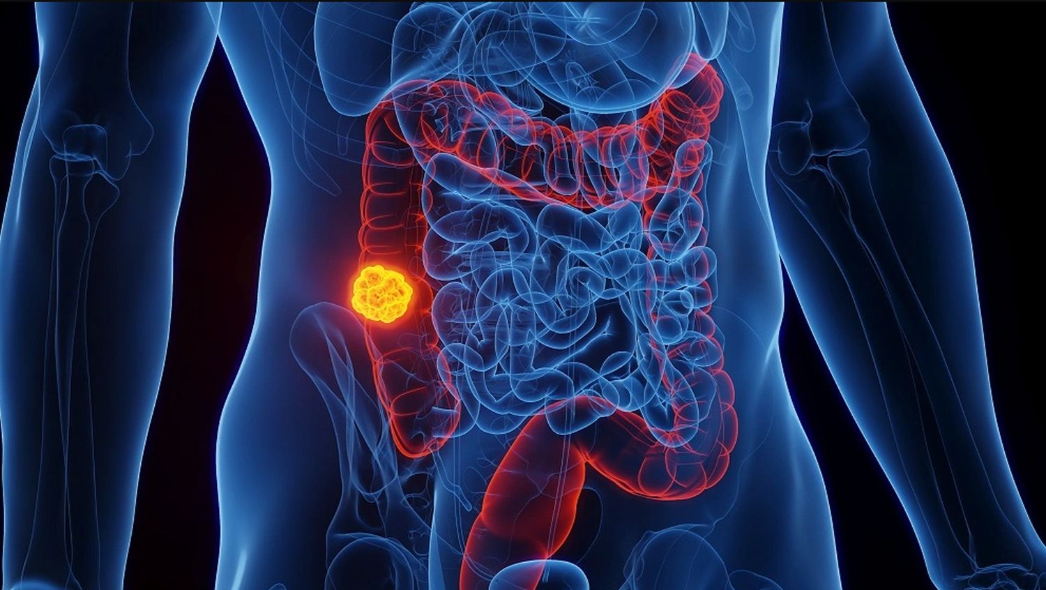 Rak debelog crijeva sve češće odnosi živote mlađih: Istraživanje otkriva ko je najugroženiji