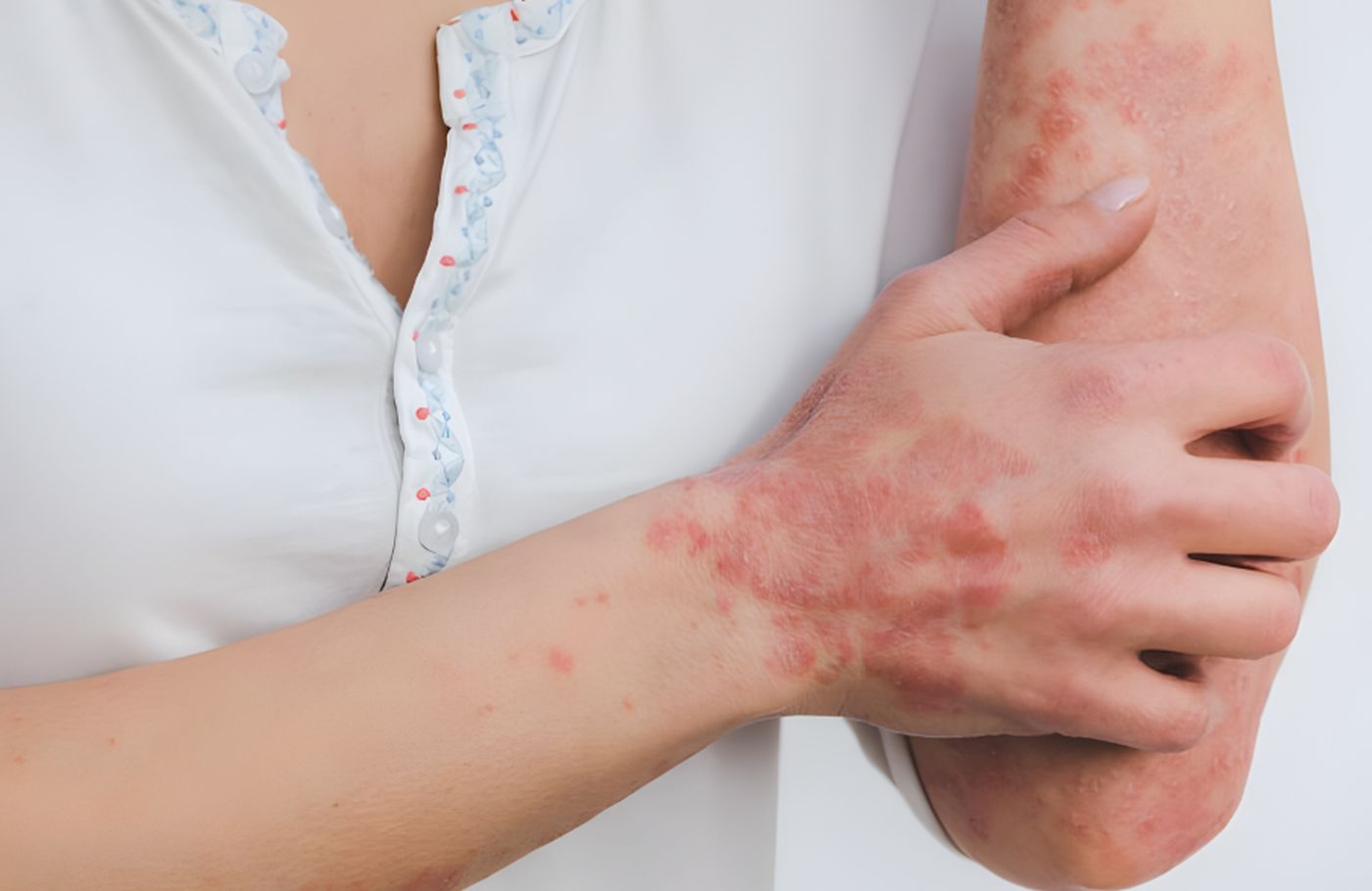 Stručnjaci ukazali na namirnice koje mogu ublažiti simptome psorijaze