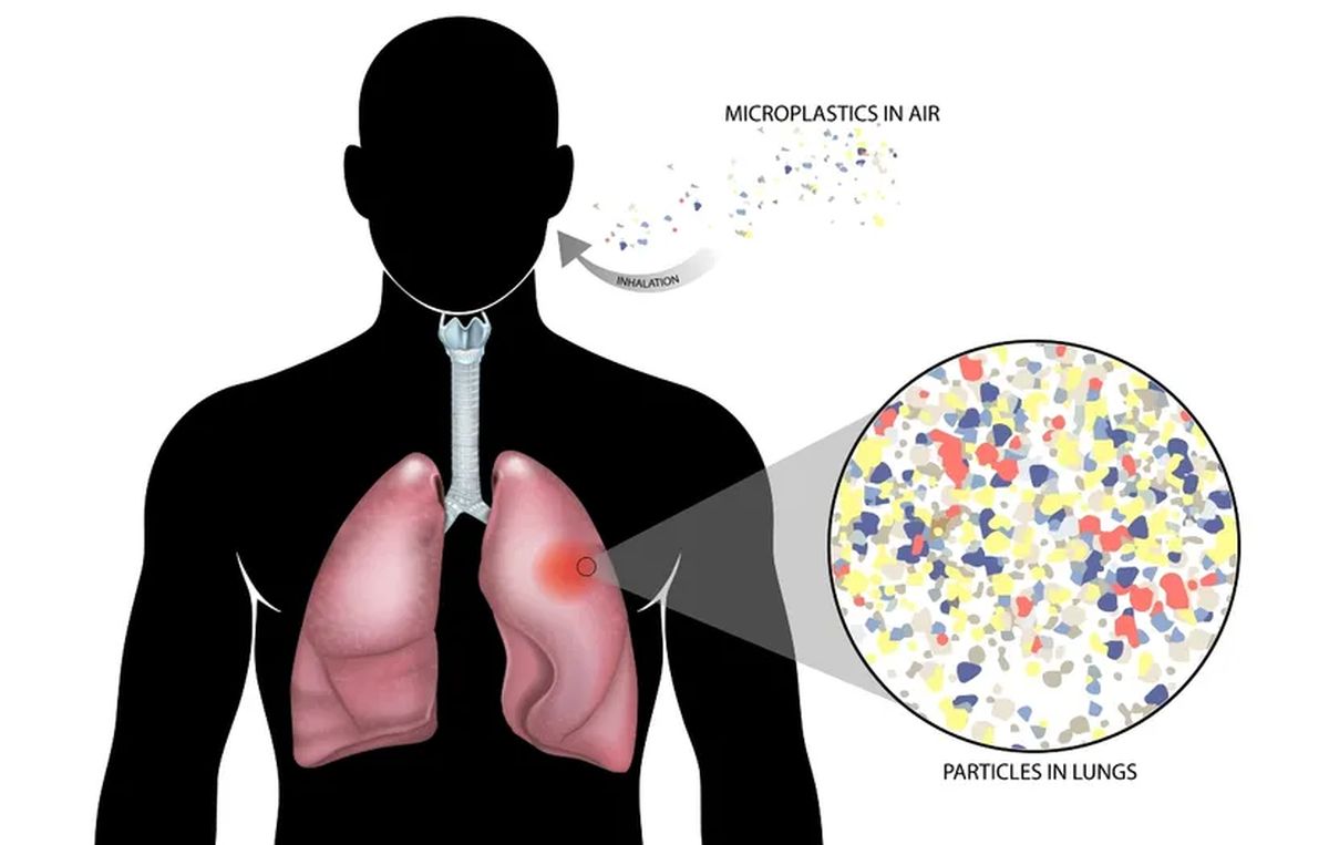 Naučnici došli do zabrinjavajućeg otkrića: Oboljeli od raka pluća imaju više mikroplastike u ovom organu
